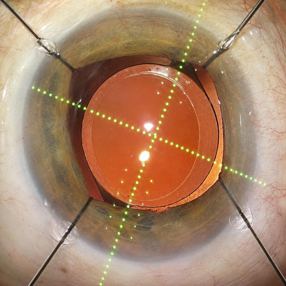 Cirurgia guiada por laser
