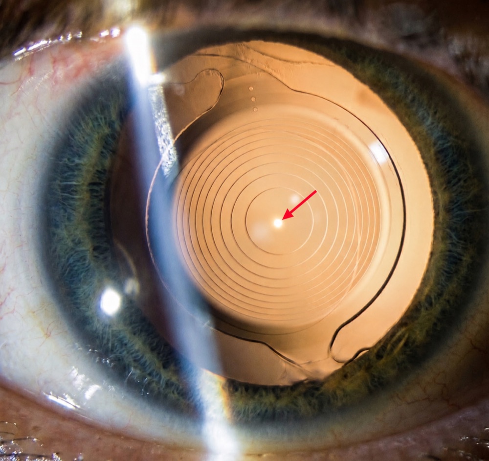 Lente multifocal implantada
